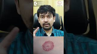 Treatment of Fungal Infection of Private Parts  Dr Rajdeep Mysore  Doctors Circle shorts [upl. by Nealah]