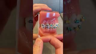 How to Use OrthoDots if Ortho Wax keeps falling off  Dr Bar The Braces Doc [upl. by Roman]