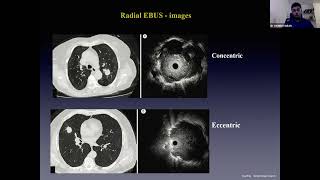 Interventional Pulmonology  Endobronchial Tuberculosis [upl. by Ailgna436]