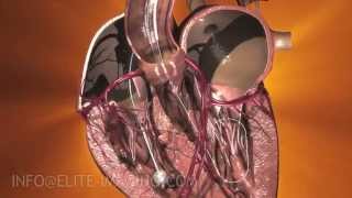 Heart Valve Implantation Full Procedure  Medical amp Scientific Video Production [upl. by Horlacher]