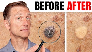 How to Remove Skin Tags and Warts Overnight  Dr Berg Explains [upl. by Ateuqirne]