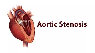 MRCP PACES AORTIC STENOSIS Station Three Cardiology [upl. by Sirad]