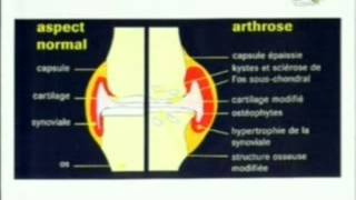 cancer et arthrose 1mpg [upl. by Michelsen]