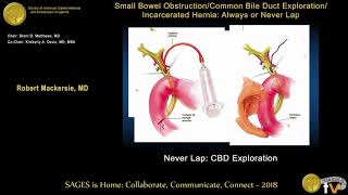 Common bile duct exploration Never laparoscopically [upl. by Esbensen401]