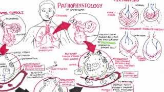 Emphysema  Pathophysiology COPD [upl. by Kilroy]