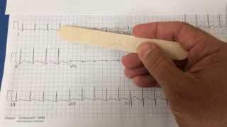 pericarditis on EKG [upl. by Odnarb]