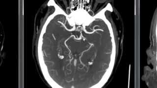 Large Artery Occlusion  Basilar [upl. by Lebiram]