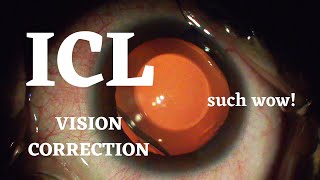 ICL Eye Surgery for Vision Correction complete [upl. by Zolnay441]