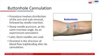 Cannulating AV Access Button holes self cannulation amp plastic needles  Dr Lalathaksha Kumbar [upl. by Ettennad]