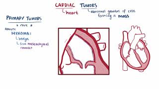 Cardiac tumors Myxoma Rhabdomyoma causes symptoms amp pathology [upl. by Hartfield416]