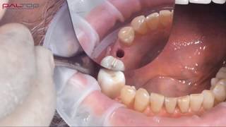 PALTOP Flapless Guided Implant Surgery using PAI  Dr Michael Klein [upl. by Hsemar]