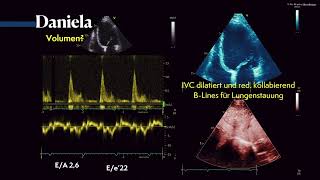 Diastolische Dysfunktion PWDoppler amp Volumenstatus im Ultraschall 〖Ultraschall〗 💘💫 [upl. by Airotkiv]