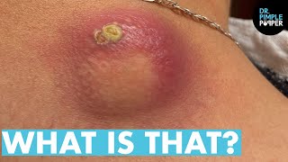 WHAT IS THAT Dr Lee Pops Satisfying Back Cyst  Dr Pimple Popper Reacts [upl. by Nova]