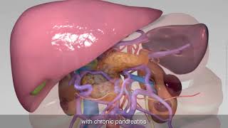 Total pancreatectomy with splenectomy right hemicolectomy and reconstruction of portal vein [upl. by Aikahc]