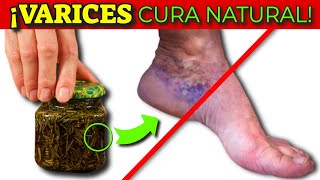 ¡QUITA las VARICES en las PIERNAS RÁPIDAMENTE  MALA CIRCULACIÓN TRATAMIENTO NATURAL [upl. by Annaierb]