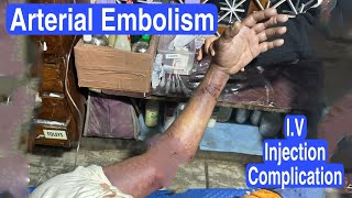 Intra Arterial injectionArterial EmbolismIntra Venous injectionDIC [upl. by Enilaf]