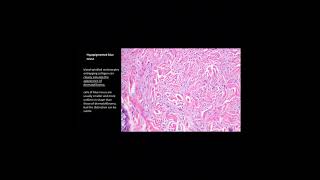 Blue nevus  Histology  understanding dermatopathology [upl. by Yle326]