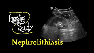 Nephrolithiasis  Renal Calculi  Ultrasound  Case 28 [upl. by Aimahs]