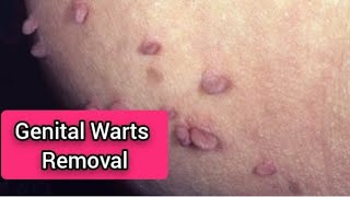 Use these creams to remove genital warts goviral [upl. by Yerkovich85]