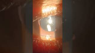 After Yag Capsulotomy  Pseudophakic [upl. by Mchenry]