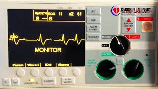 Second degree type II AV block with PVCs [upl. by Narrad]