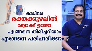 DVT Treatment കാലിലെ രക്തക്കുഴലിൽ ബ്ലോക്ക് ഉണ്ടോ എങ്ങനെ തിരിച്ചറിയാം \ Deep vein thrombosis DVT [upl. by Africa681]