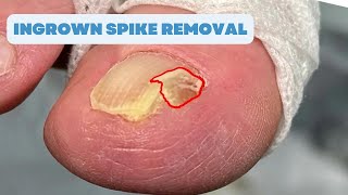 Ingrown SPIKE Removal FAILED SURGERY [upl. by Scrivenor]