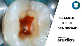 Cracked Tooth Syndrome – A Spectrum of Treatment Choices  Weekly Wisdom 🦷 [upl. by Juliana]