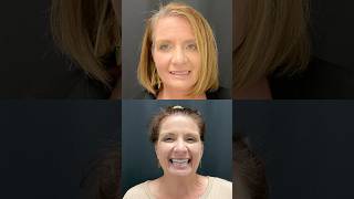 Smile Transformations You Need to See🤩🦷 allon4dentalimplants smilemakeover [upl. by Tratner]