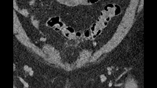 Epiploic appendagitis Clinical case  CT scan [upl. by Trista292]