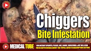 Chiggers Jiggers Trombiculidae Infestation Extraction  Causes and Treatment [upl. by Ellerahs]