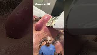 Watch this pore spatula in action 🍴credit basemkhaled123 on TT doctor satisfying viral [upl. by Davy]