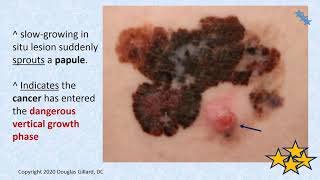 Malignant Melanoma The Most Deadly Form of Skin Cancer Primary Health Care Providers Cant Miss It [upl. by Gerhardt]