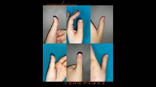 Brachydactyly Type D distraction lengthening brachydactyly doctor thumb meganfox [upl. by Ennairam910]