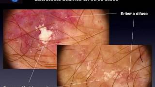 UERATOSIS ACTINICAS Y ENFERMEDAD DE BOWEN  Dr Renato Bakos [upl. by Rosenblatt117]