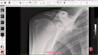 Upper Extremity Case Conference Shoulder Girdle [upl. by Barnaba120]