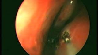 Reducción de cornetes inferiores con láser diodo de 980nm  Inferior turbinates with 980nm diode l [upl. by Guntar]