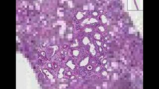 Histopathology KidneyRapidly progressive glomerulonephriti [upl. by Cowden637]