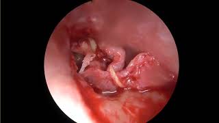 Endoscopic tympanoplasty with Cartilage ossiculoplasty [upl. by Tankoos]