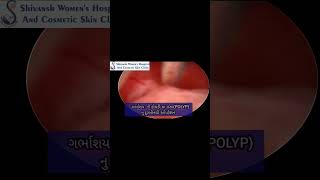 Hysteroscopic Polyp Removal [upl. by Ahsatan]