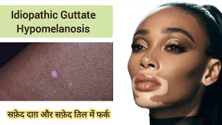 Idiopathic Guttate Hypomelanosis  सफ़ेद तिल और सफ़ेद दाग़ में फर्क IGH vitiligo leucoderma सफ़ेद [upl. by Yllier]