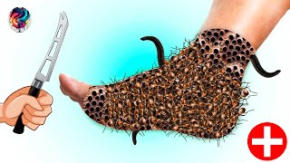 😱😱😱Epic ASMR Parasite Removal Watch These Worms and Ticks Get Extracted for Ultimate Satisfaction [upl. by Gretel]