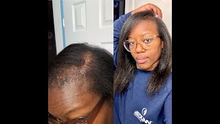 Alopecia Hair Growth Update 2022 [upl. by Leclair]