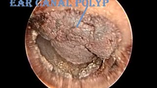 Otoendoscopic Dried Hemorrhagic Ear Canal Polyp Removal [upl. by Eliath]