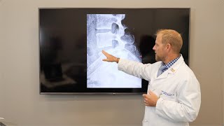 Understanding Degenerative Disc Disease Through A Patient’s Journey  Causes Symptoms amp Treatments [upl. by Anniken324]