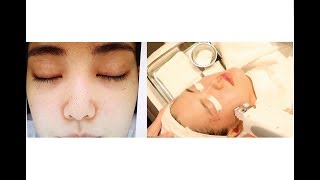 Michelle Choi gets Intracel Microneedling in Korea  Seoul Guide Medical [upl. by Canale]