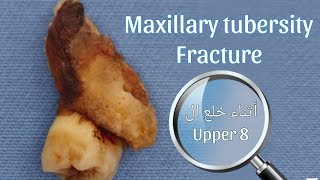 كسر ال maxillary tuberosity أثناء خلع ال Upper 8 هتتعامل ازاي ؟ [upl. by Ittocs755]