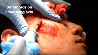 Dermabrasion Smoothing Acne Scar Skin [upl. by Eirdua]