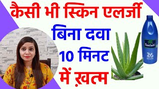 एलर्जी का इलाज  urticaria ka ilaj  skin allergy ka gharelu upay  pitti ka ilaj [upl. by Mungam]