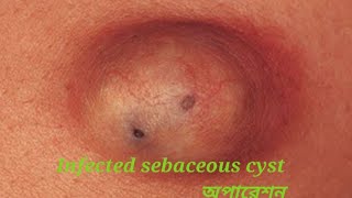 INFECTED SEBACEOUS CYST REMOVAL [upl. by Riancho]